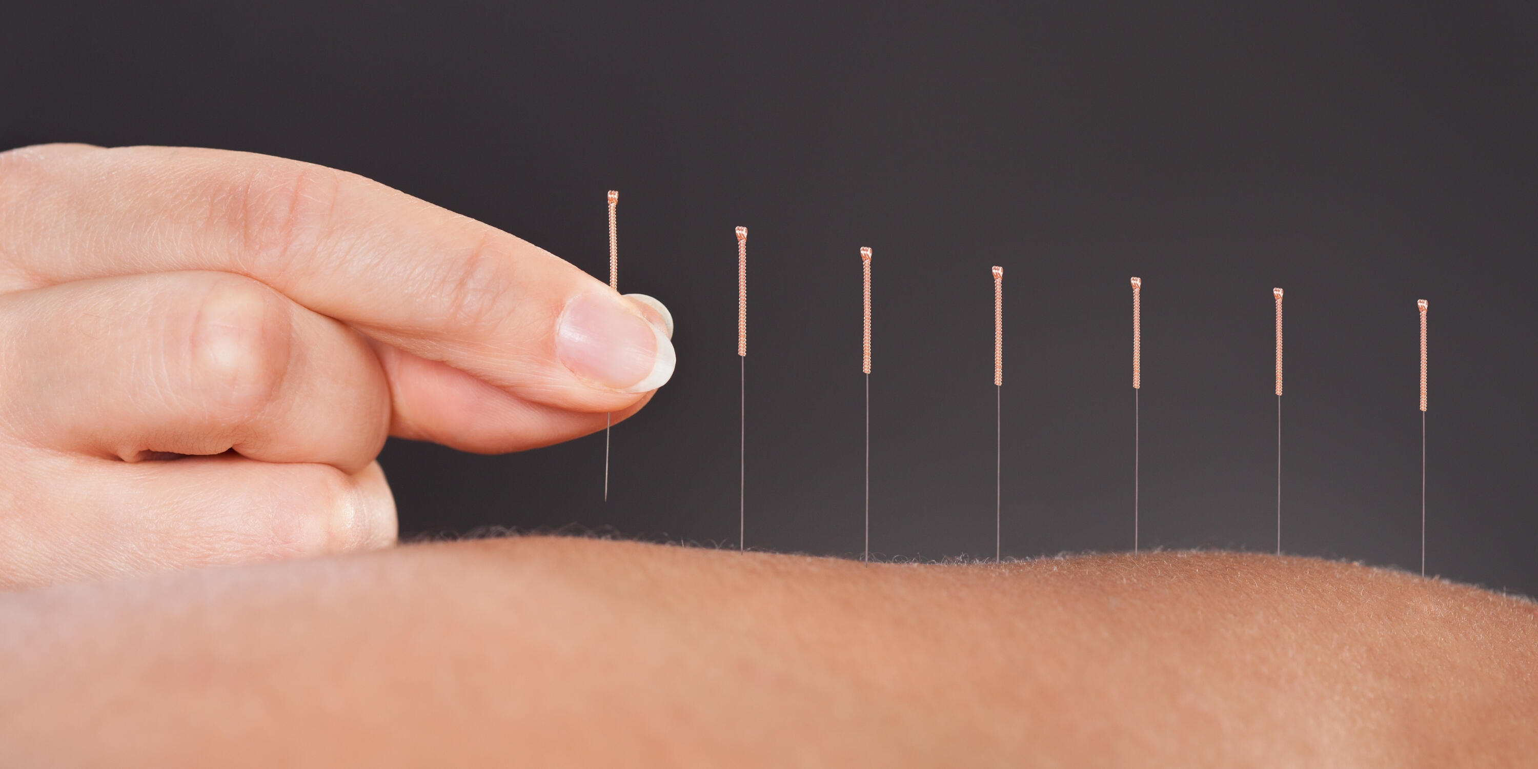 Akupunktur behandlingsform